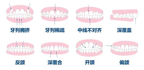 上排牙齒蓋住下排牙齒|深咬也是一種咬合問題！有7種可能原因與6種風險 